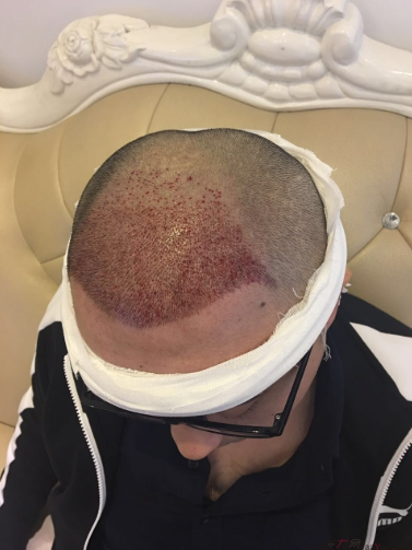 三級脫發(fā)植發(fā)，在鄭州大麥微針植發(fā)2700pse+200ptt+st&nbsp;