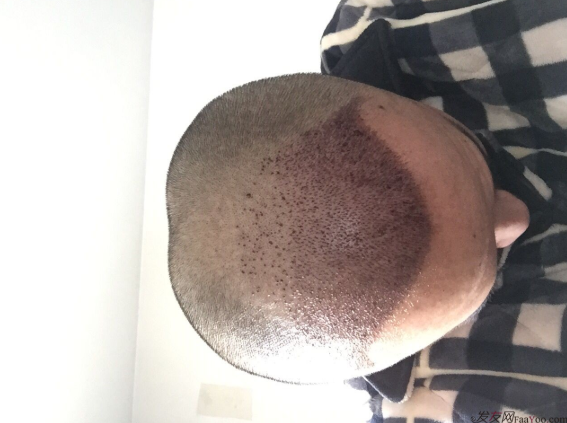 三級脫發(fā)植發(fā)，在鄭州大麥微針植發(fā)2700pse+200ptt+st&nbsp;