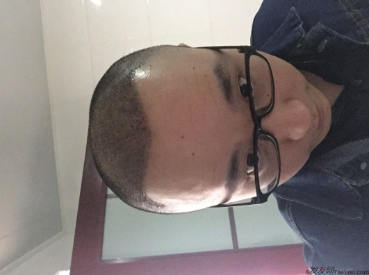 三級脫發(fā)植發(fā)，在鄭州大麥微針植發(fā)2700pse+200ptt+st&nbsp;