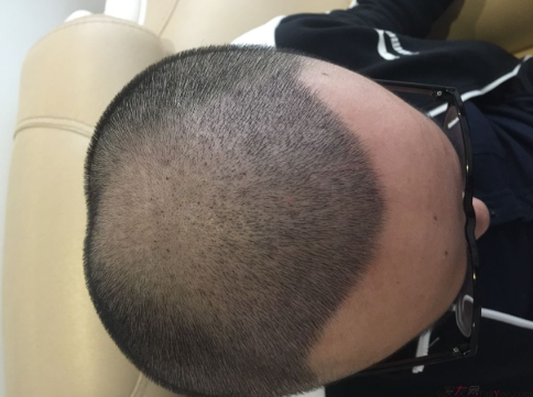 三級脫發(fā)植發(fā)，在鄭州大麥微針植發(fā)2700pse+200ptt+st&nbsp;