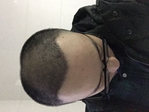 三級脫發(fā)植發(fā)，在鄭州大麥微針植發(fā)2700pse+200ptt+st&nbsp;