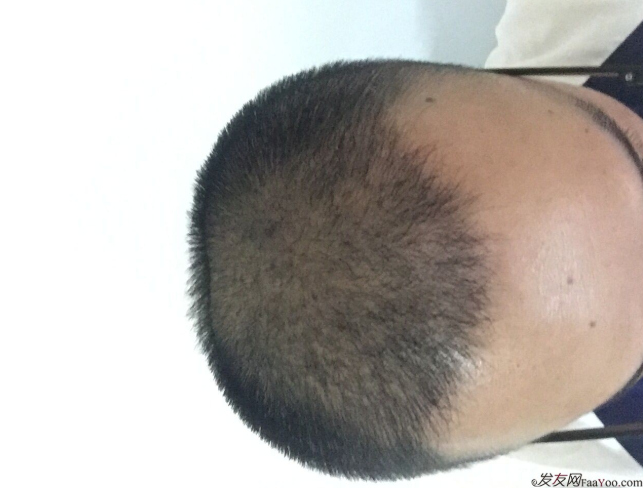 三級脫發(fā)植發(fā)，在鄭州大麥微針植發(fā)2700pse+200ptt+st&nbsp;