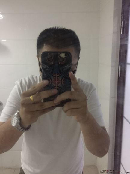 三級脫發(fā)植發(fā)，在鄭州大麥微針植發(fā)2700pse+200ptt+st&nbsp;