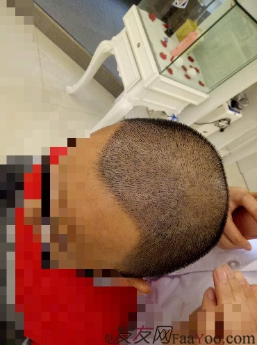 我在青島大麥微針植了發(fā)，3600單位期待我的蛻變