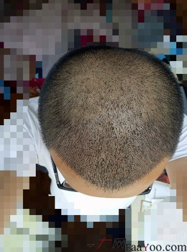 我在青島大麥微針植了發(fā)，3600單位期待我的蛻變