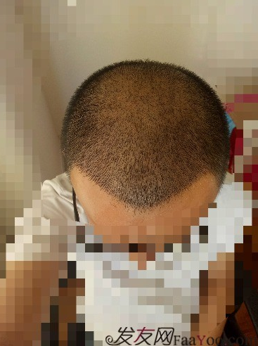 我在青島大麥微針植了發(fā)，3600單位期待我的蛻變