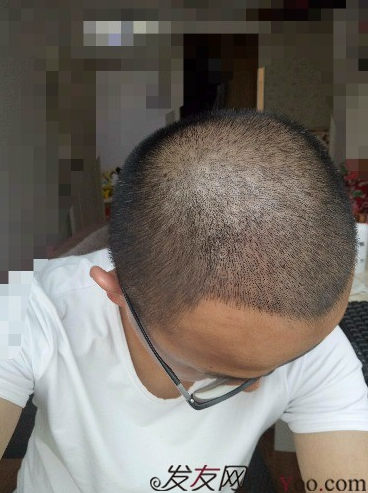 我在青島大麥微針植了發(fā)，3600單位期待我的蛻變