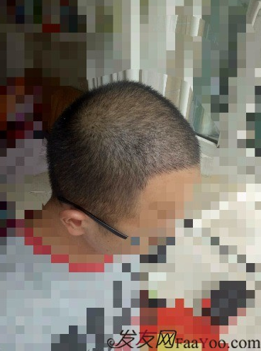 我在青島大麥微針植了發(fā)，3600單位期待我的蛻變