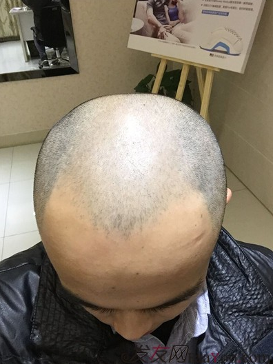 長沙大麥微針植發(fā)3510單位，一步步變帥的過程