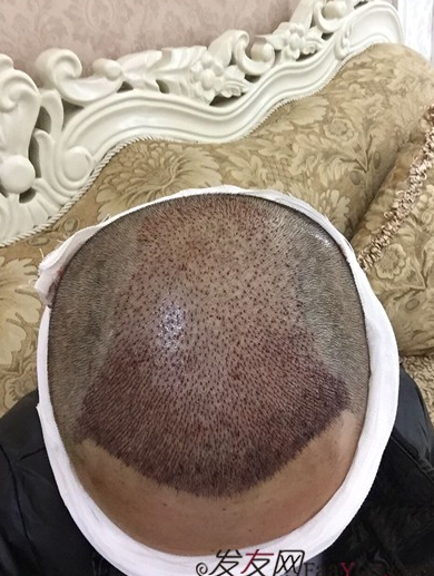 長沙大麥微針植發(fā)3510單位，一步步變帥的過程