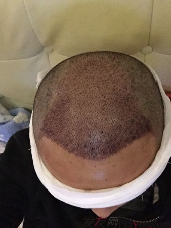 長沙大麥微針植發(fā)3510單位，一步步變帥的過程