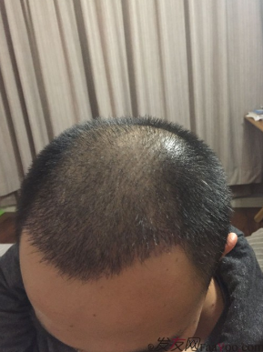 長沙大麥微針植發(fā)3510單位，一步步變帥的過程