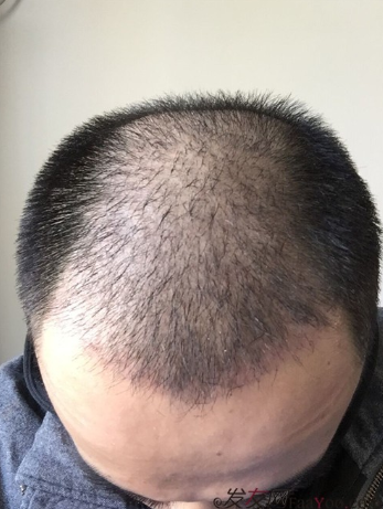 長沙大麥微針植發(fā)3510單位，一步步變帥的過程