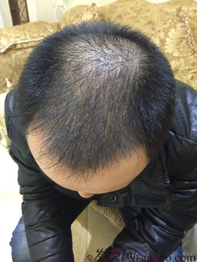 長沙大麥微針植發(fā)3510單位，一步步變帥的過程