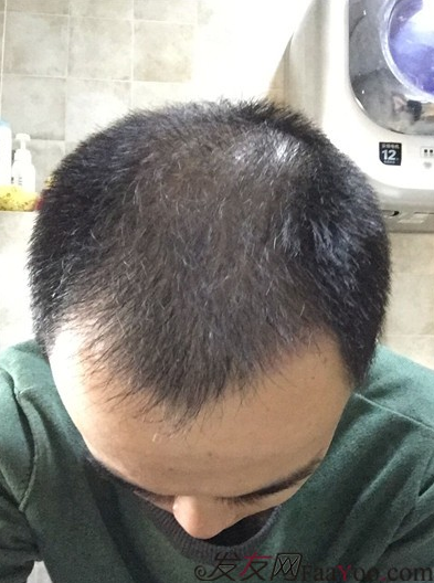 長沙大麥微針植發(fā)3510單位，一步步變帥的過程