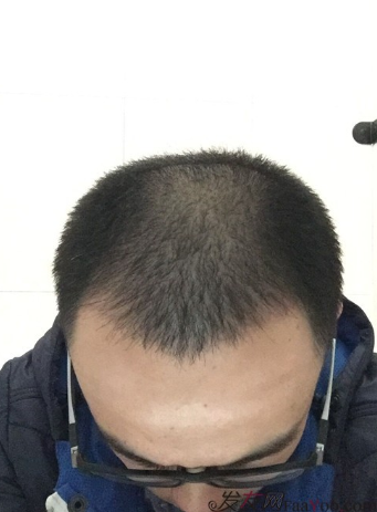 長沙大麥微針植發(fā)3510單位，一步步變帥的過程