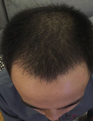 長沙大麥微針植發(fā)3510單位，一步步變帥的過程