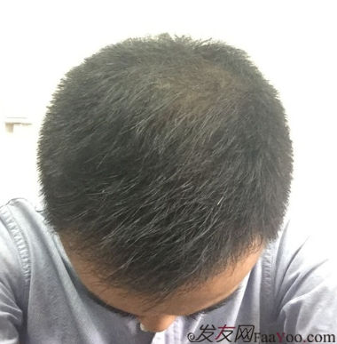 長沙大麥微針植發(fā)3510單位，一步步變帥的過程