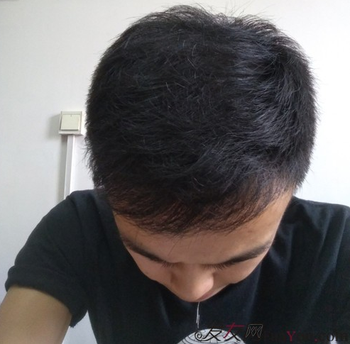 長沙大麥微針植發(fā)3510單位，一步步變帥的過程