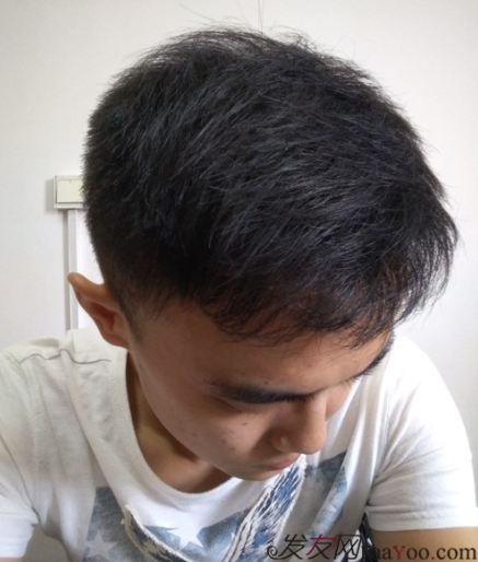 長沙大麥微針植發(fā)3510單位，一步步變帥的過程