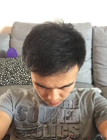 長沙大麥微針植發(fā)3510單位，一步步變帥的過程