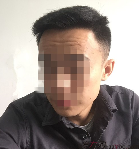 長沙大麥微針植發(fā)3510單位，一步步變帥的過程