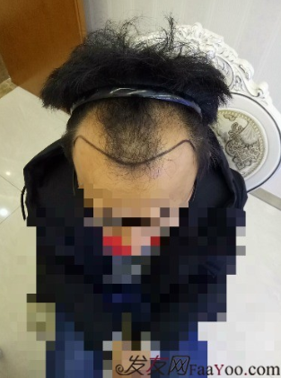 我在青島大麥微針植了發(fā)，3600單位期待我的蛻變