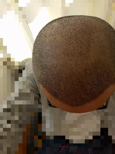 我在青島大麥微針植了發(fā)，3600單位期待我的蛻變