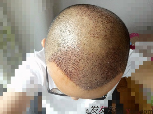 我在青島大麥微針植了發(fā)，3600單位期待我的蛻變