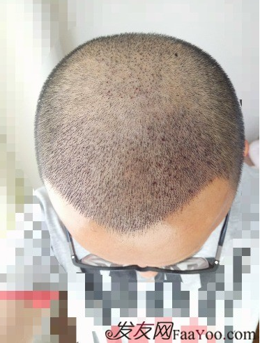 我在青島大麥微針植了發(fā)，3600單位期待我的蛻變