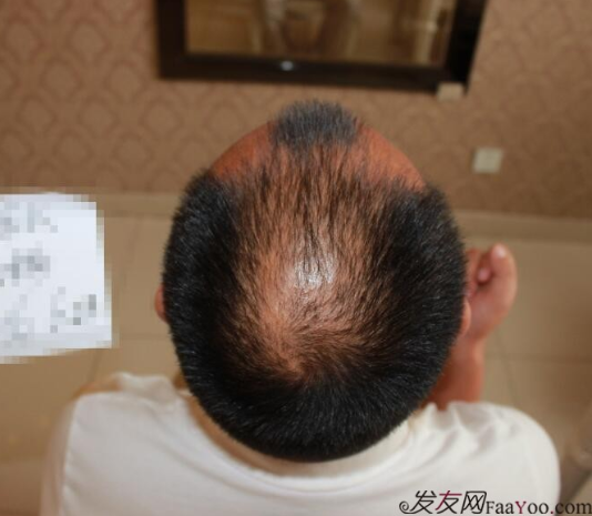 5級脫發(fā)植發(fā)經(jīng)歷，選來選去最終還是成都大麥微針給了我自信
