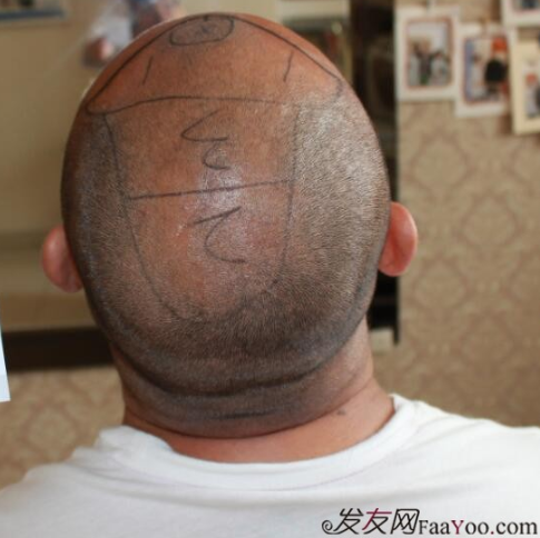 5級脫發(fā)植發(fā)經(jīng)歷，選來選去最終還是成都大麥微針給了我自信