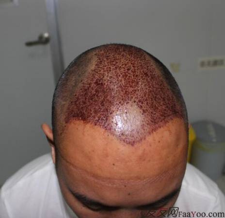 5級脫發(fā)植發(fā)經(jīng)歷，選來選去最終還是成都大麥微針給了我自信