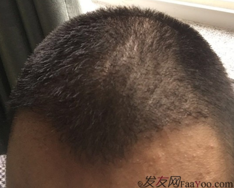 5級脫發(fā)植發(fā)經(jīng)歷，選來選去最終還是成都大麥微針給了我自信