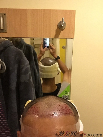 從頭開始，大家陪我一起渡過難關，我的植發(fā)日記