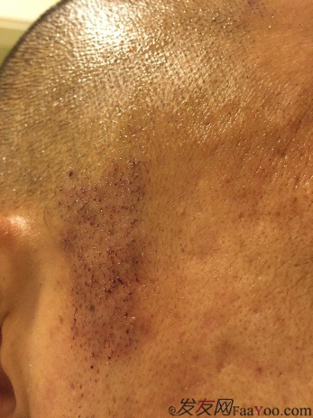 從頭開始，大家陪我一起渡過難關，我的植發(fā)日記