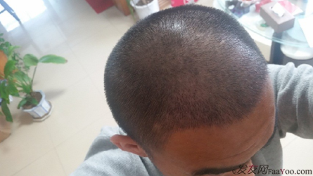 從頭開始，大家陪我一起渡過難關，我的植發(fā)日記