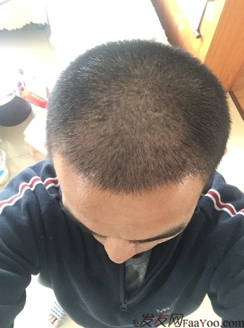 從頭開始，大家陪我一起渡過難關，我的植發(fā)日記