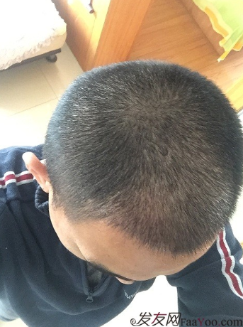 從頭開始，大家陪我一起渡過難關，我的植發(fā)日記