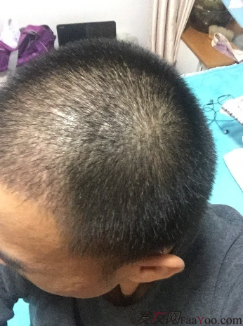 從頭開始，大家陪我一起渡過難關，我的植發(fā)日記