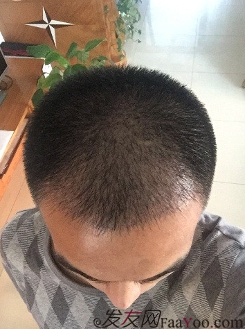 從頭開始，大家陪我一起渡過難關，我的植發(fā)日記