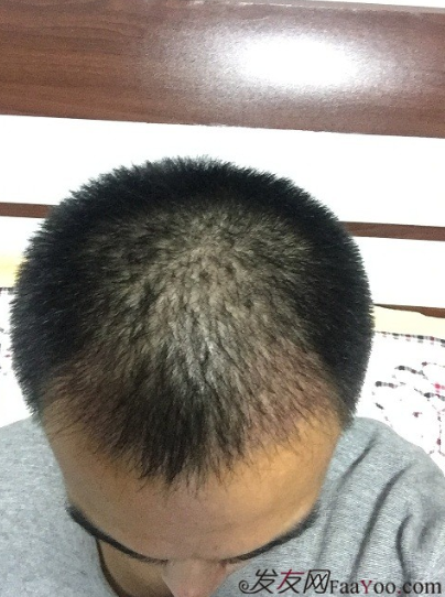 從頭開始，大家陪我一起渡過難關，我的植發(fā)日記