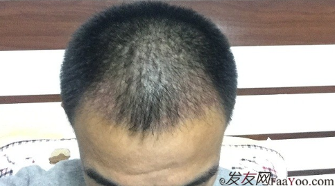 從頭開始，大家陪我一起渡過難關，我的植發(fā)日記