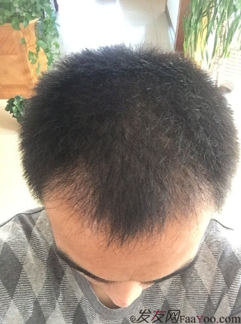 從頭開始，大家陪我一起渡過難關，我的植發(fā)日記