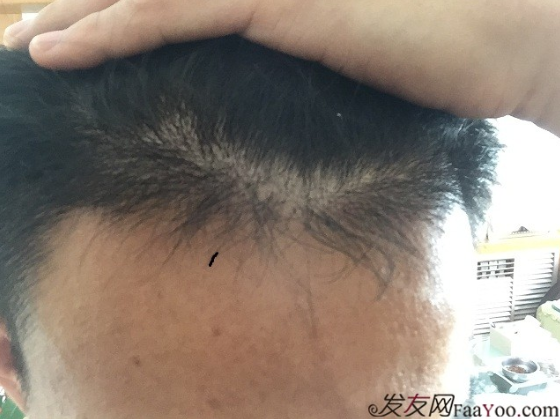 從頭開始，大家陪我一起渡過難關，我的植發(fā)日記