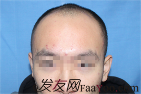 北京植發(fā)記PSH無痕加密3500毛囊單位，術(shù)后一年對比一下