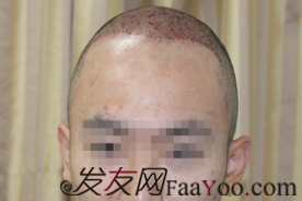 北京植發(fā)記PSH無痕加密3500毛囊單位，術(shù)后一年對比一下