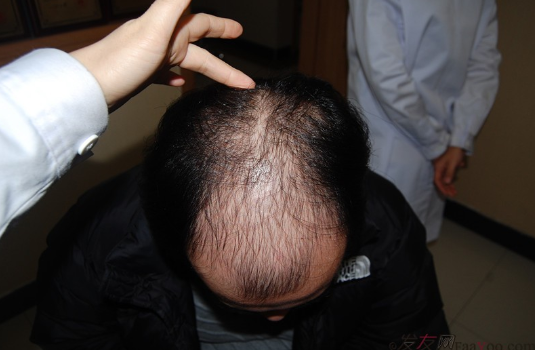 5級脫發(fā)大麥微針植發(fā)經(jīng)歷，三年時間兩次手術(shù)6800單位追求完美效果