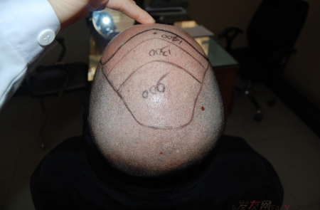 5級脫發(fā)大麥微針植發(fā)經(jīng)歷，三年時間兩次手術(shù)6800單位追求完美效果