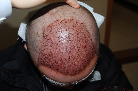 5級脫發(fā)大麥微針植發(fā)經(jīng)歷，三年時間兩次手術(shù)6800單位追求完美效果